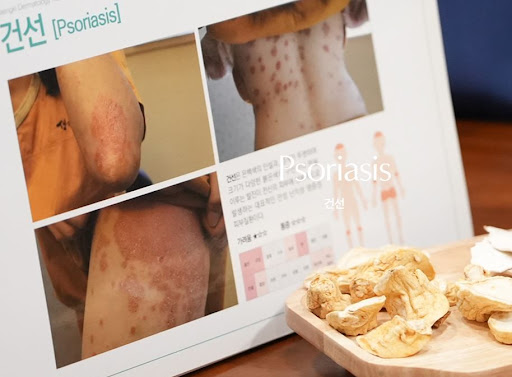 생기한의원 건선 페이지에서 다루는 물방울 건선 증상 특징