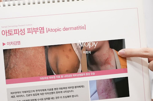 생기한의원 아토피 페이지에서 살펴보는 두피 아토피 정보